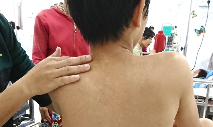 Bị bạn phóng kéo làm đứt mạch máu: Cháu bé chảy máu ồ ạt