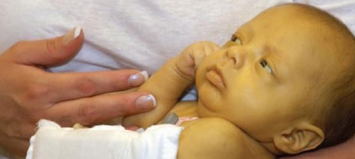 Thấy con vàng da sậm, đưa đến viện ngay không bại não, tử vong