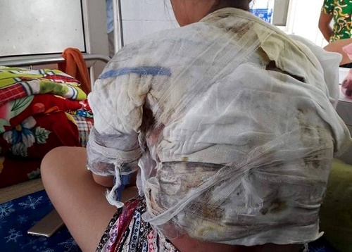 Khởi tố gã chồng dội nước sôi vào người vợ mới cưới