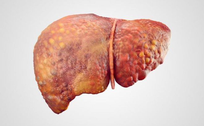 Chuyên gia hàng đầu BV Bạch Mai chỉ 4 nguyên nhân, 7 dấu hiệu ung thư gan không nên bỏ qua