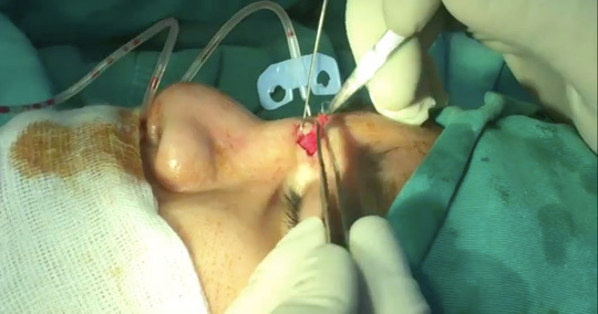 Sau khi làm thẩm mỹ 2 năm, phát hiện gạc bác sĩ để quên trong hốc mũi