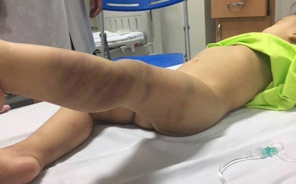 Bé trai hơn 1 tuổi người chằng chịt vết bầm tím, bị bỏ lại bệnh viện
