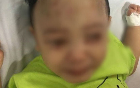 Sức khỏe của bé trai 1 tuổi bị bạo hành ở Hà Nội tiến triển tốt