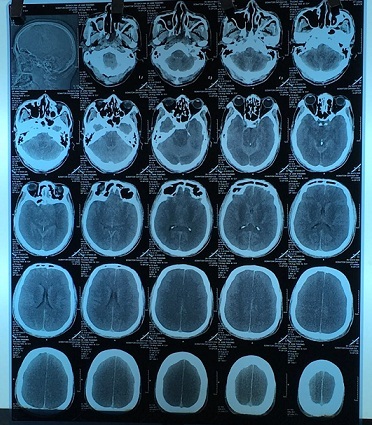 Tử vong sau khi mua cồn sát trùng về uống thay rượu