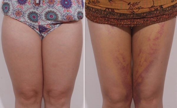 Hút mỡ đùi: Chân chưa kịp thon đã phải nhập viện