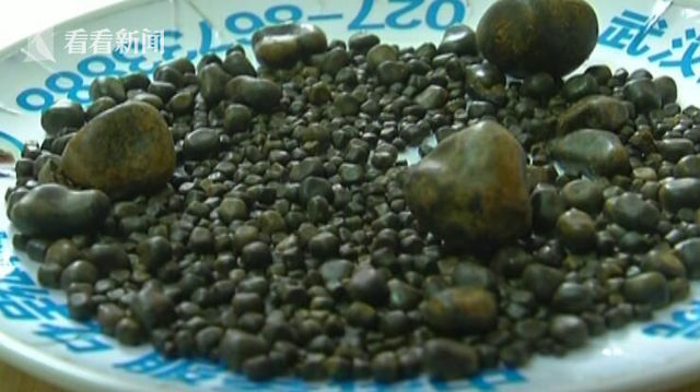 Bà cụ tích hơn 800 viên sỏi mật trong cơ thể