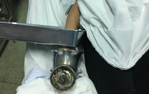 Kinh hãi tay người phụ nữ bị cuốn trong máy xay thịt