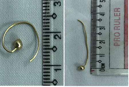 Nuốt chiếc hoa tai, bé gái 7 tháng tuổi phải nhập viện cấp cứu