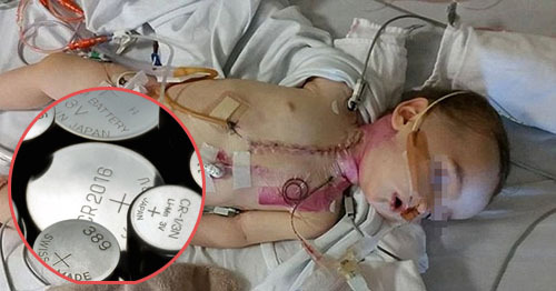 Cảnh báo: Bé gái 3 tuổi chịu đau đớn khi mắc pin khuy trong mũi