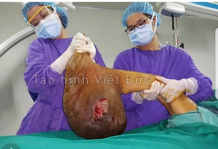 Phép màu đến với người phụ nữ mang “bàn chân voi” nặng 10kg suốt 39 năm
