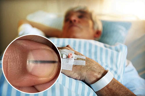 Móng tay có vệt đen, cẩn thận vì có thể là dấu hiệu của bệnh ung thư