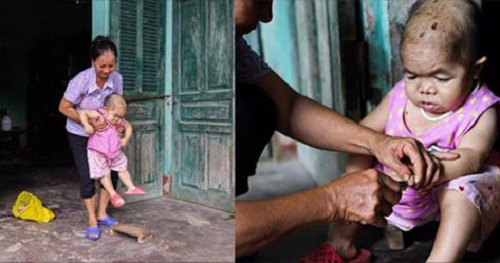 Cô gái gần 30 vẫn mang hình hài của đứa trẻ 2 tuổi: Lủi thủi trong nhà cả đời, không có bạn cùng chơi