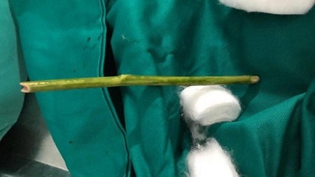 Cô gái 27 tuổi liều mạng tự ý phá thai, đặt que vào tử cung để cầm máu