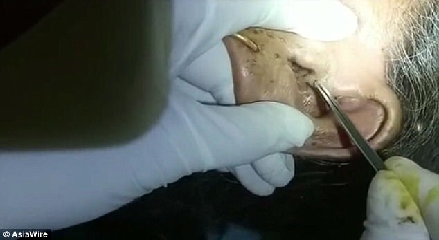 Kinh hoàng phát hiện ổ dòi 30 con trong tai cụ bà U80