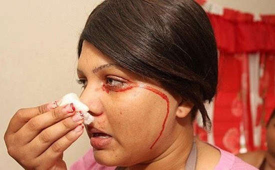 Hội chứng kỳ lạ khiến người ra “mồ hôi máu” liên tục