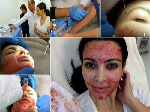 Hãi hùng trước phương pháp làm đẹp da bằng máu của phái đẹp