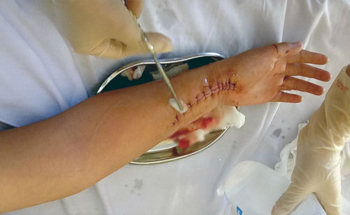 Rách cổ tay sau khi đấm vỡ cửa kính: Điều gì khiến nam sinh sợ hãi?