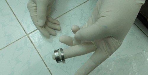 Bé trai 13 tuổi suýt hoại tử vì tự đeo nhẫn vào 'của quý'