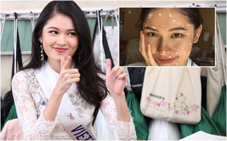 Thùy Dung bất ngờ bị thuỷ đậu trước thềm chung kết Miss International 2017