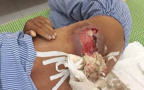 Chữa bệnh theo lời 'lang băm', người đàn ông bị hoại tử da nghiêm trọng