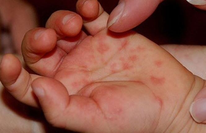 Bệnh nhi 7 tháng tuổi tử vong vì mắc tay chân miệng