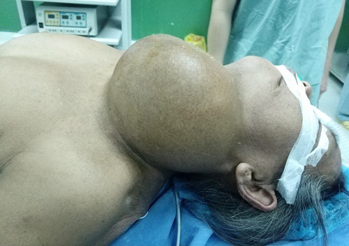 Cắt bỏ thành công khối u nặng 2kg nằm trên cổ bệnh nhân suốt 40 năm