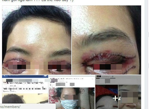 Giật thót mình nhìn đôi mắt biến dạng sau khi cắt mí tại spa 'chui'