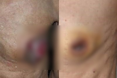 Chuyện khó tin nhưng có thật, nam giới cũng mắc ung thư vú