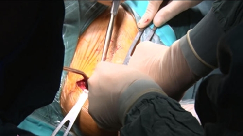 Nghệ An lần đầu tiên thực hiện thay khớp vai thành công