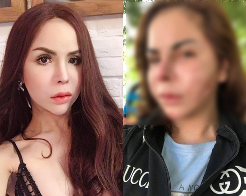 Giật mình với gương mặt biến dạng của hot girl chuyển giới Linda sau khi nạo silicon