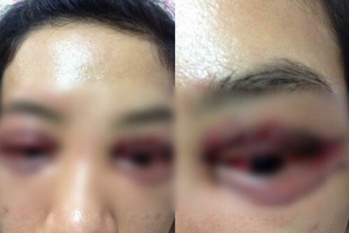 Biến dạng sau cắt mí: Người bảo lãnh cho nạn nhân bị dọa 