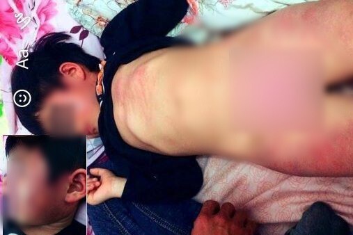 Vụ bé gái 4 tuổi bị bầm tím toàn thân: Do bị các bạn cùng lớp đánh?