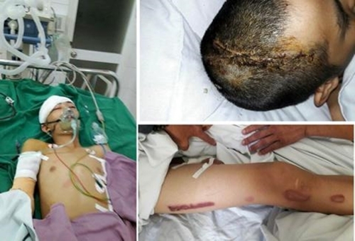 Vụ trộm vặt bị chủ nhà chém trọng thương: “Cháu van xin nhưng bác ấy không tha…”