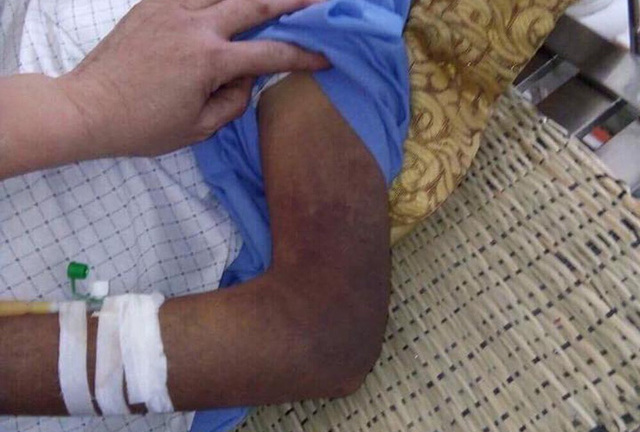 Xử lý con trai đánh bố gãy xương sườn, mẻ bánh chè