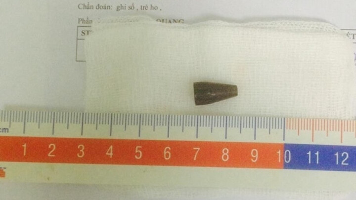 Đầu bút bi chui tọt vào đường thở bé 8 tuổi