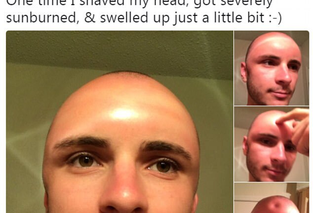 Ham phơi nắng, nam thanh niên bị phỏng rộp mặt