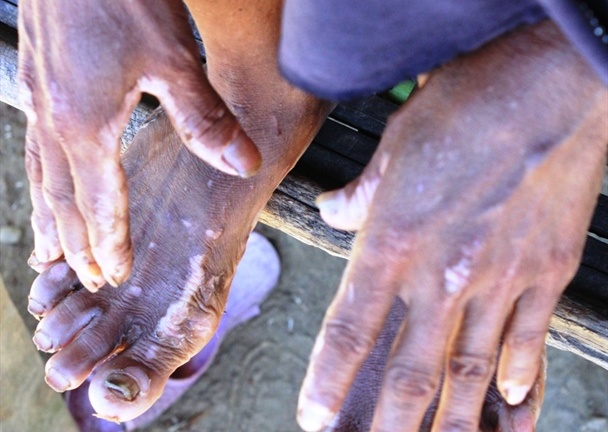 Nguy cơ tái phát bệnh viêm da dày sừng tay chân ở Quảng Ngãi