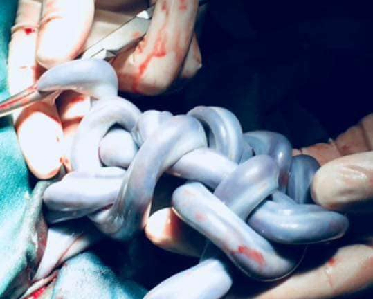 Kỳ lạ ca sinh đôi dây rốn kết thành tràng