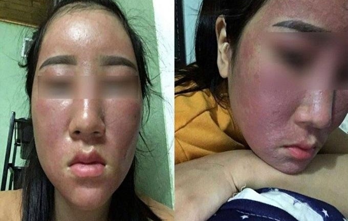 Những loại kem dưỡng trắng hủy hoại da không kém gì kem trộn vẫn đang 'che mắt' phái đẹp