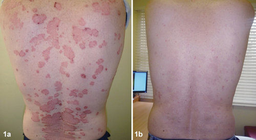 Kiểm soát bệnh vẩy nến hiệu quả bằng thảo dược Dr Michaels