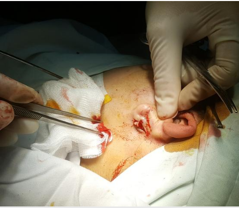 Hi hữu: Nút nhựa hoa tai chui tọt trong vành tai bé gái 14 tuổi