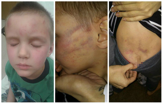 Bé trai 5 tuổi bị bạn trai của mẹ bạo hành dã man vì tội 