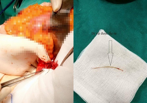 Ăn cá, cụ bà bị xương dài 4cm đâm thủng ruột