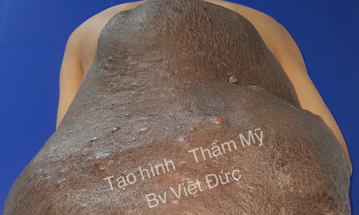 Cắt bỏ khối u khổng lồ 15kg trên lưng