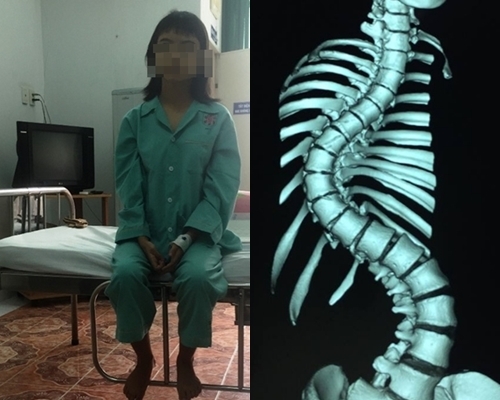 Sau phẫu thuật xương sống, cô gái cao thêm 7cm