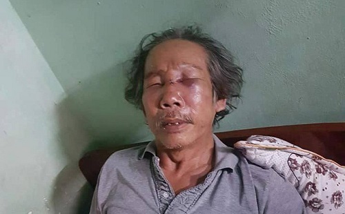 Bảo vệ chung cư đánh cụ ông gần 70 tuổi gãy mũi