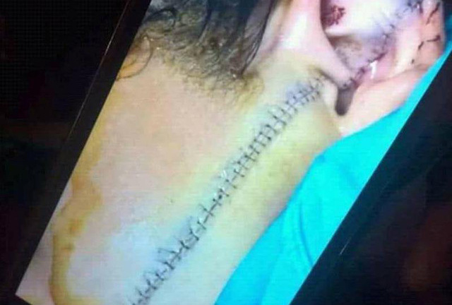 Khởi tố vụ nữ sinh bị rạch mặt do mâu thuẫn ở chợ