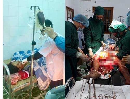 Ngân hàng máu sống cứu kịp thời ngư dân bị sắt đâm thấu đùi, mất 2 lít máu