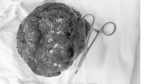 Sút cân, nôn ra máu mới biết mang khối u nặng 2kg trong dạ dày