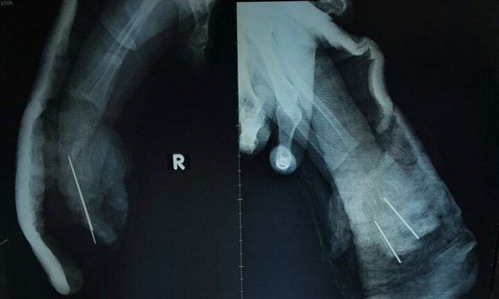 Bé 2 tuổi bị dây xích xe máy cắt đứt lìa bàn tay